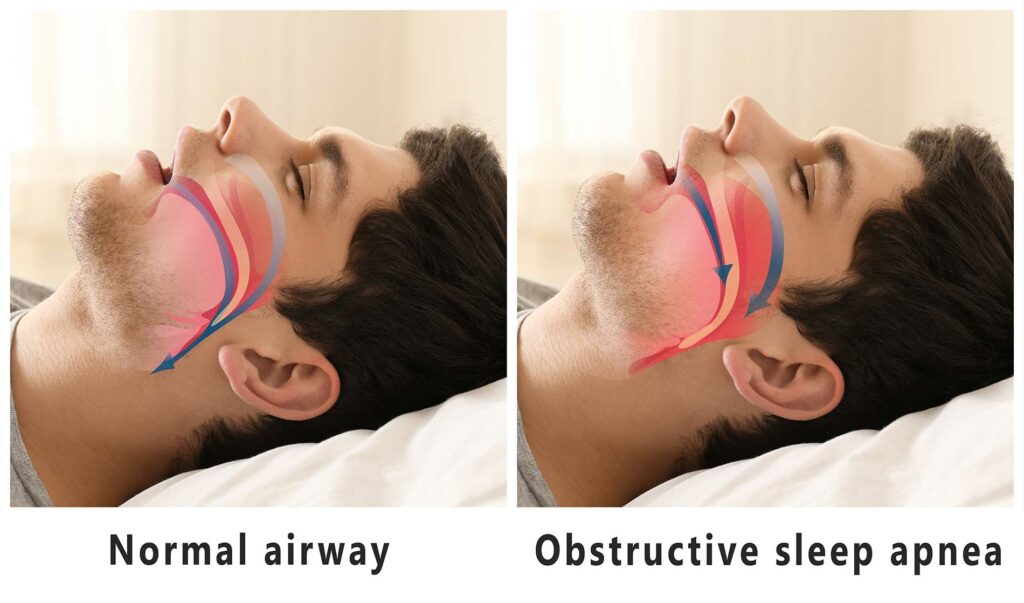 airways when you sleep-sleep-apnea