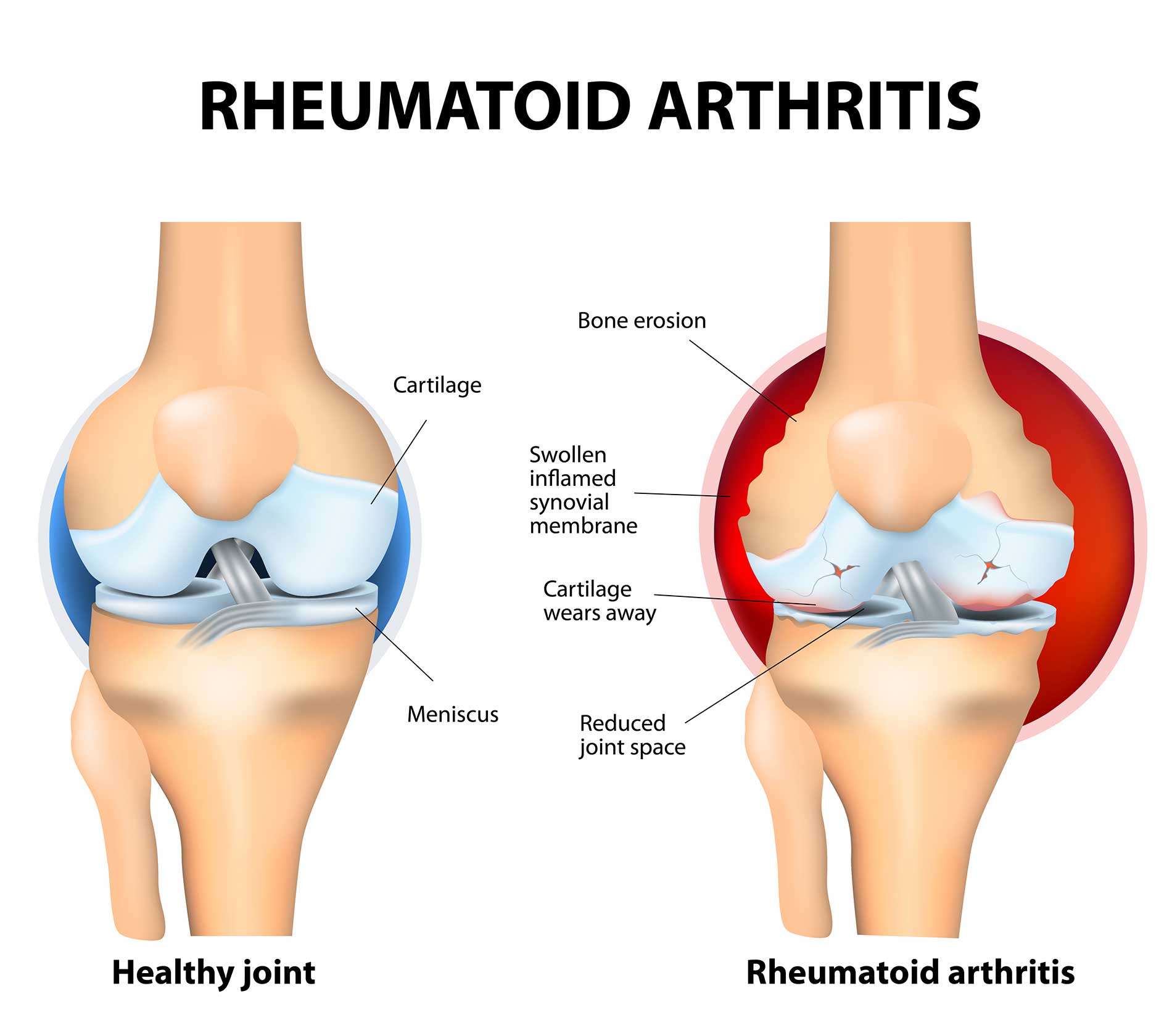 featuredimage-What-is-rheumatoid-arthritis