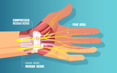 What You Need to Know About Carpal Tunnel Syndrome